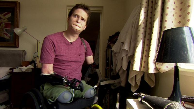 The Quadruple Amputee Who Needs The Correct Prosthetic Bbc News