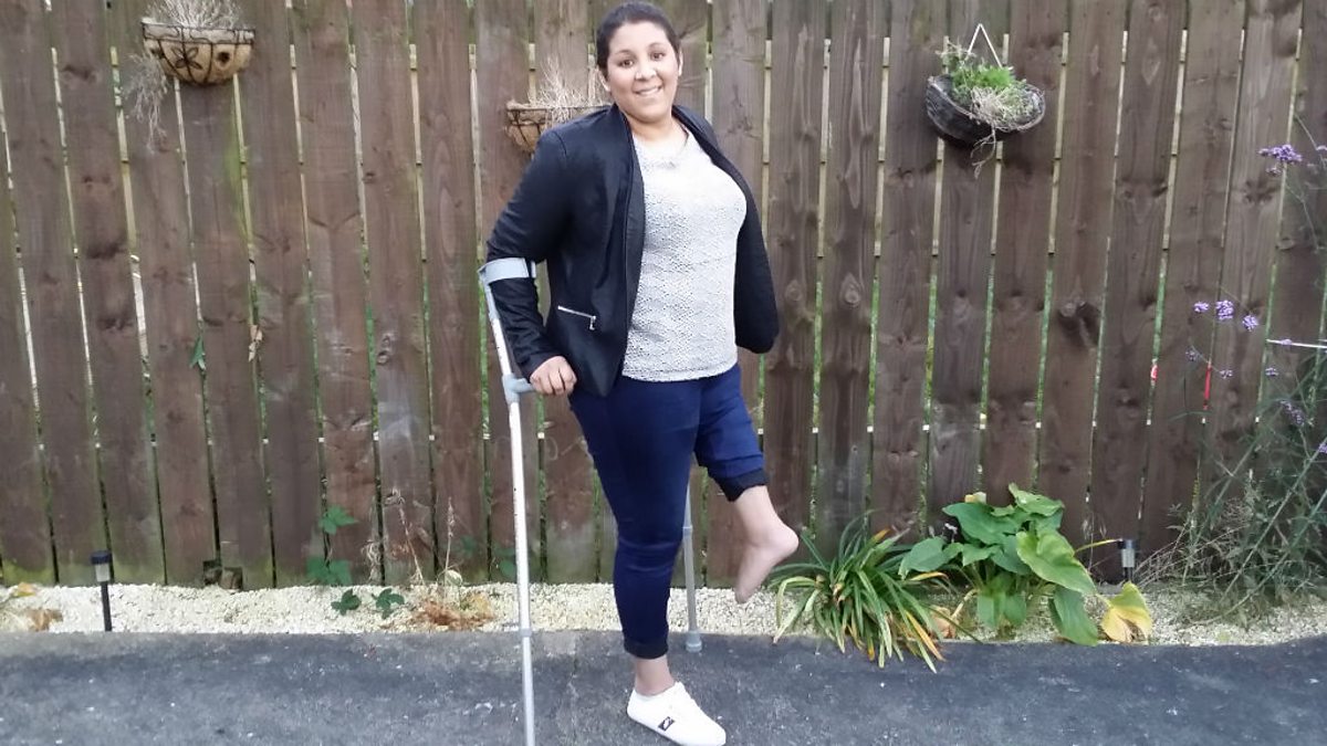 Bbc Radio Live Live In Short Amputee Gets A New Knee Using Her Backwards Foot