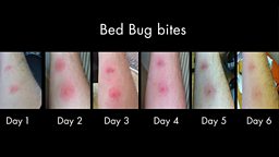 When the bed bug bites