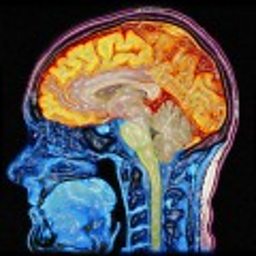 Enhanced MRI scan of the head 