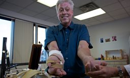 Double Hand-Transplant