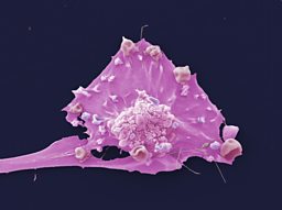 New research into breast cancer reclassifies the disease into 10 different subtypes