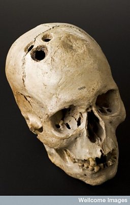 Trepanned Skull