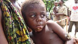 Lesions created by the tropical disease Yaws