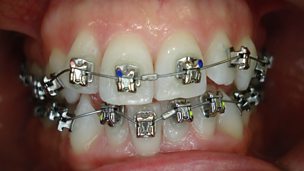 Image for Why are middle aged women chosing braces?