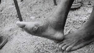 Image for Guinea Worm Disease is 'relatively contained'