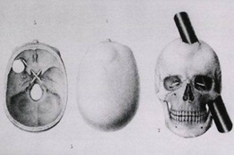 Phineas Gage's skull with bar