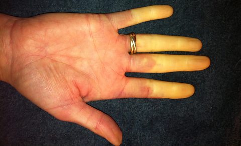 Rosie Toon's hand with Raynaud's