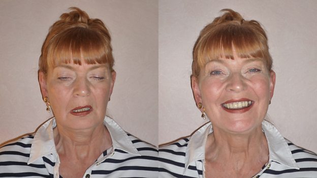 What Is Myasthenia Gravis What Is Myasthenia Gravis