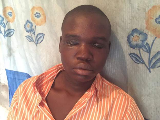 19-year-old man Hussain Emmanuel says his eyes were removed by people who wanted to use them for ritual purposes in the northern Nigerian state of Bauchi