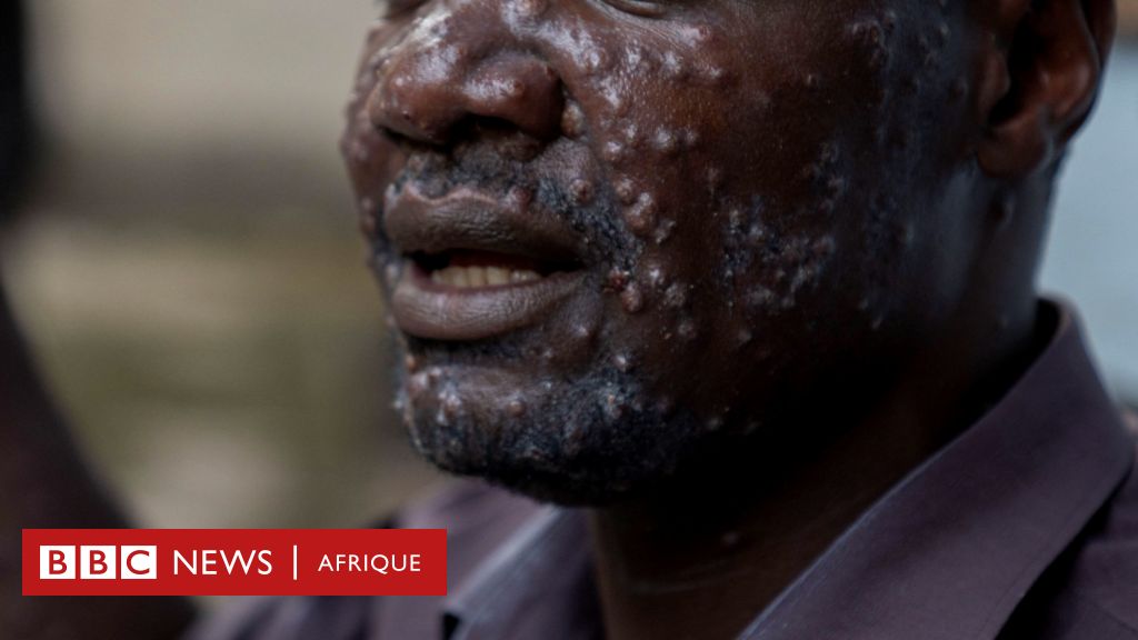 Mpox La Variole Du Singe D Clar E Urgence Sanitaire En Afrique Que