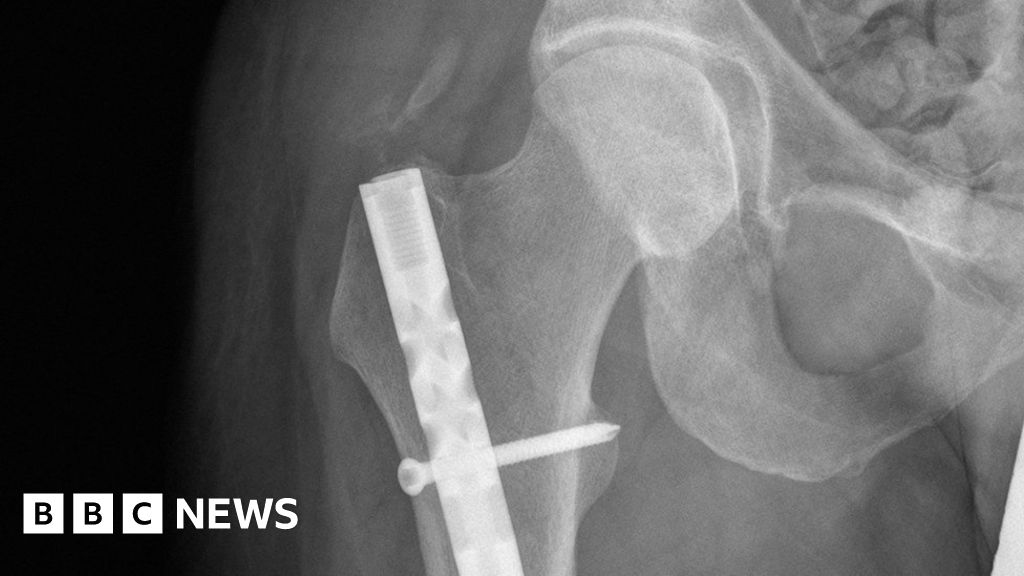 Early Hip Fracture Surgery Will Save Hundreds Of Lives Bbc News