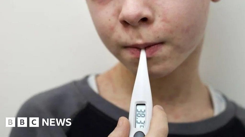 Wales Measles Cases Rise As Outbreak In South East Reaches 17