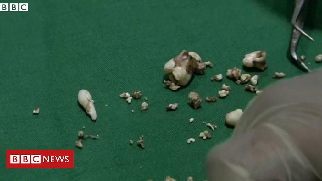 Menino Tem 526 Dentes Removidos Da Boca Bbc News Brasil