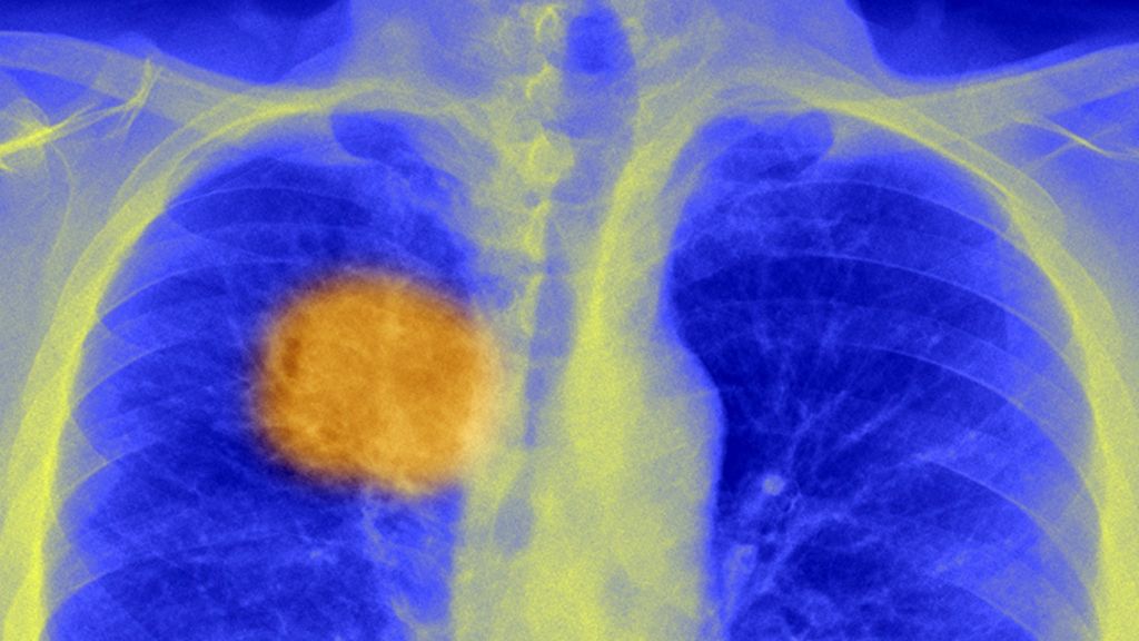 Scientists 'find cancer's Achilles heel' BBC News