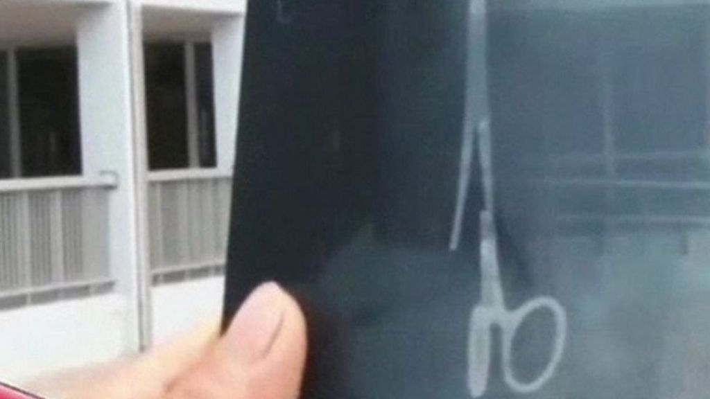 Forceps removed from stomach after 18 years