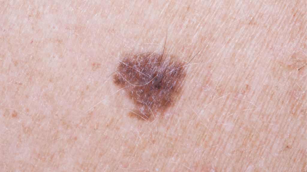 Arm Mole Count predicts Skin Cancer Risk BBC News