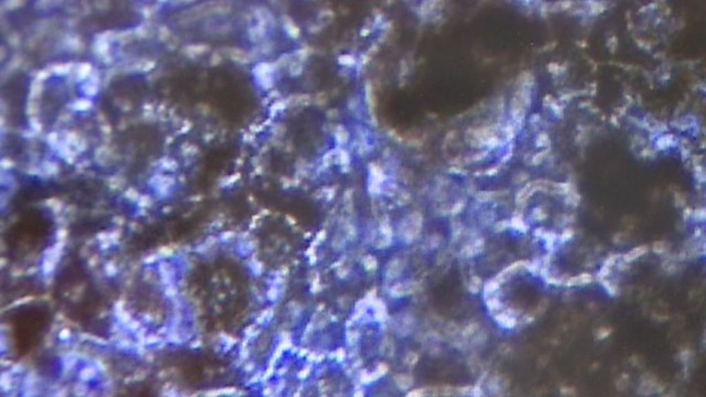 Surgeons test possible stem cell cure for blindness bbc news