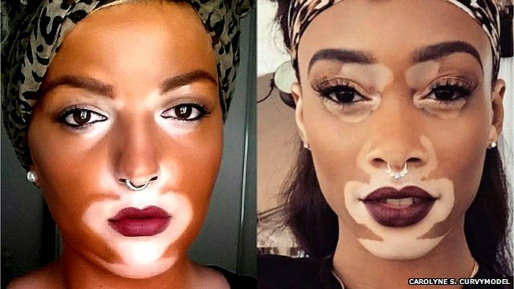 The Model Whos Bringing A Rare Skin Condition Into The Open Bbc News