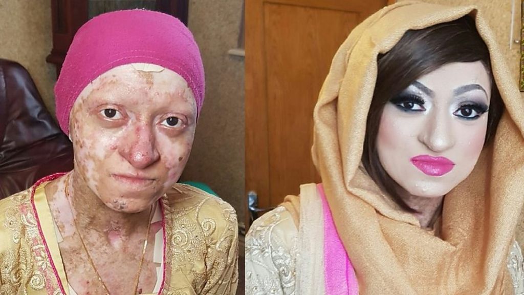 The woman with 'butterfly skin' says she feels 'blessed'