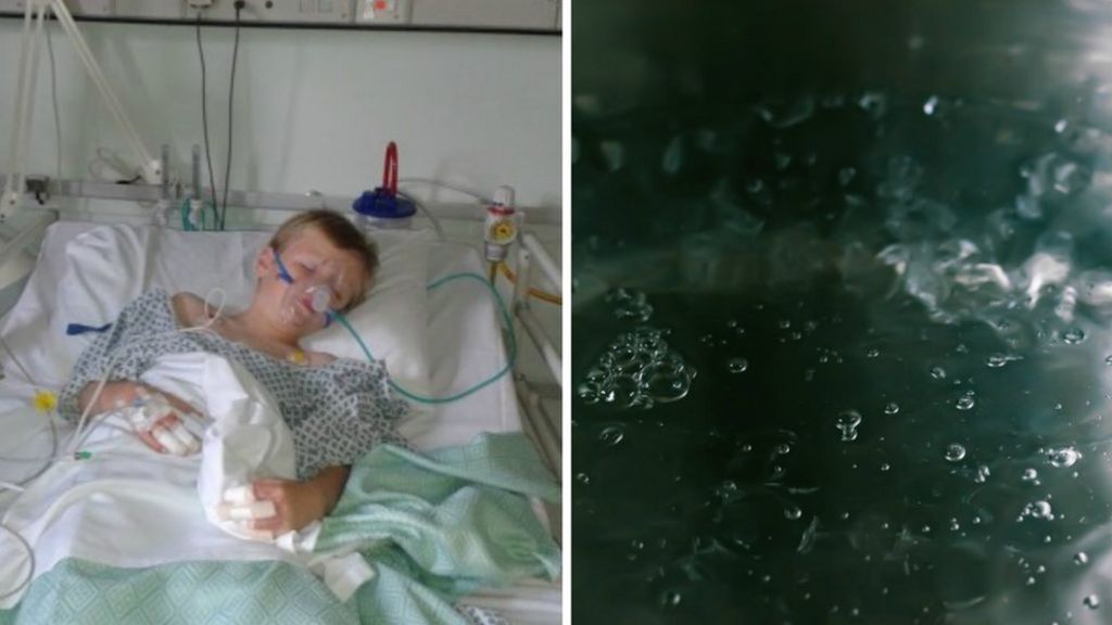 Burns warning over children's steam treatment for colds BBC News