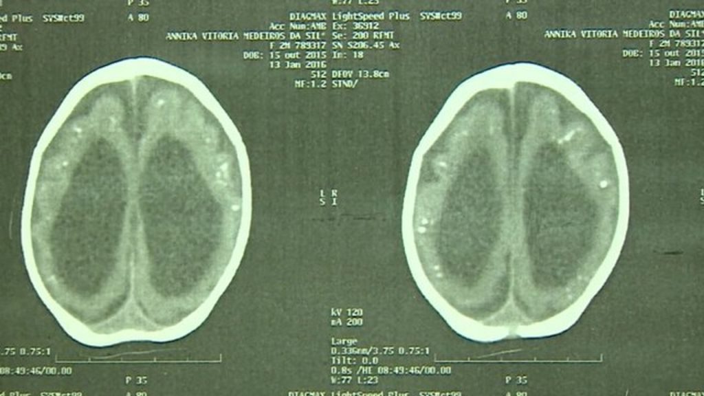 VIDEO: Evidence may link Zika and birth defects