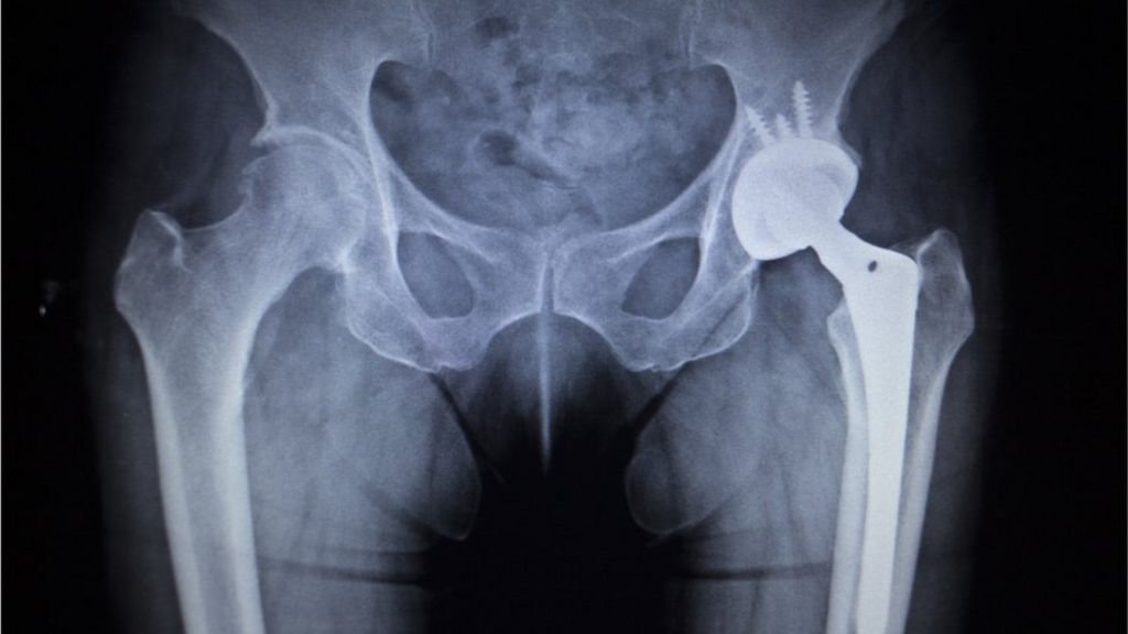 Cuts planned to Worcestershire hip and knee operations