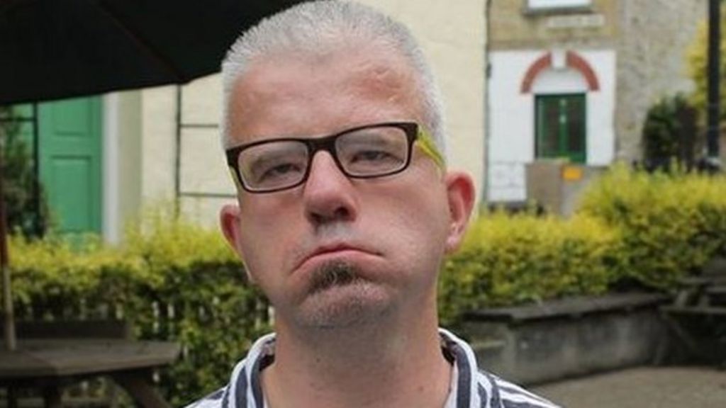 'Drunk' facial palsy man turned away