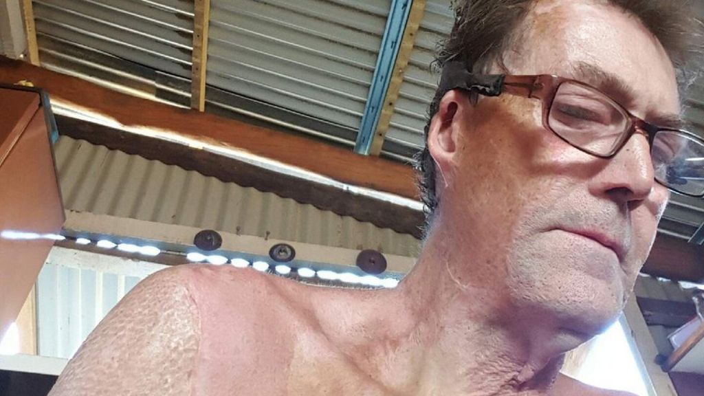 'I set myself on fire'