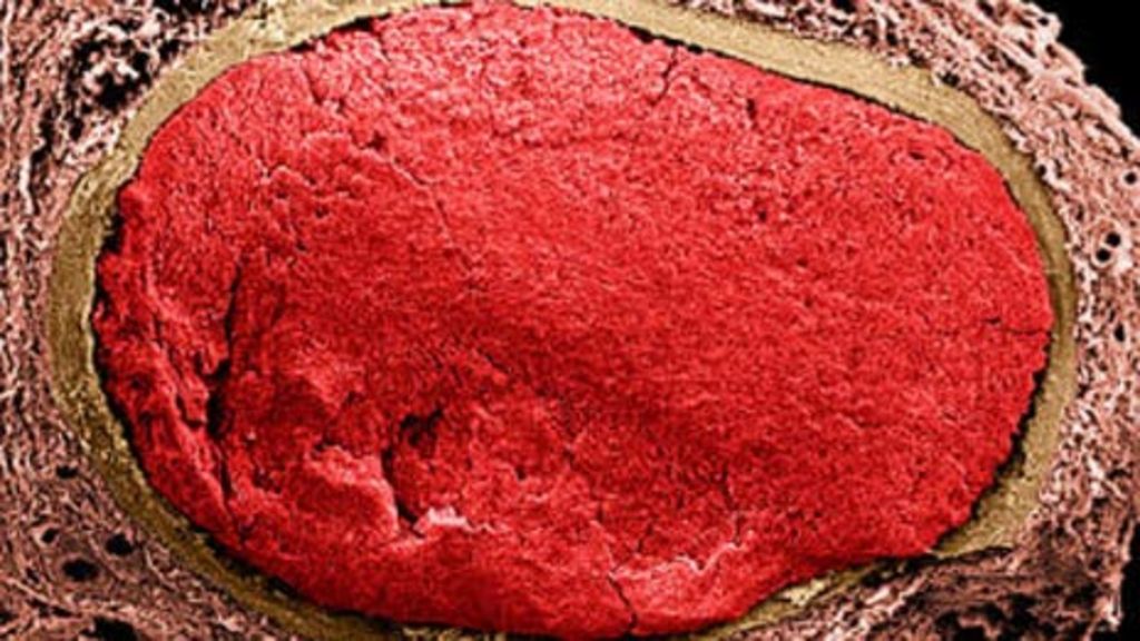 NHS 'failure' to spot blood clots costing millions BBC News