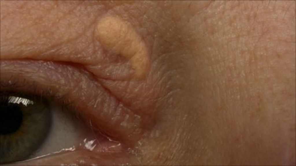 Eyelid Marks Warn Of Heart Attack Bbc News