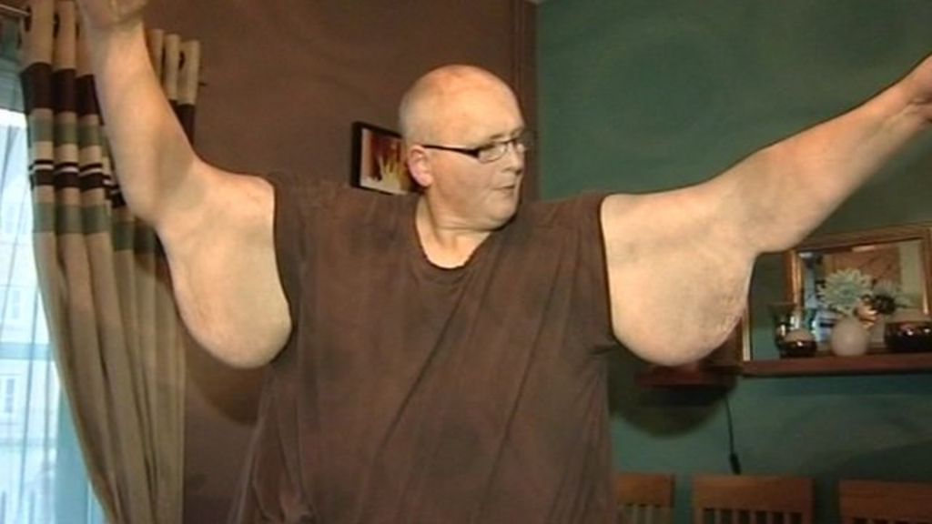 Surgery Hope As Worlds Fattest Man Sheds 46 Stone Bbc News