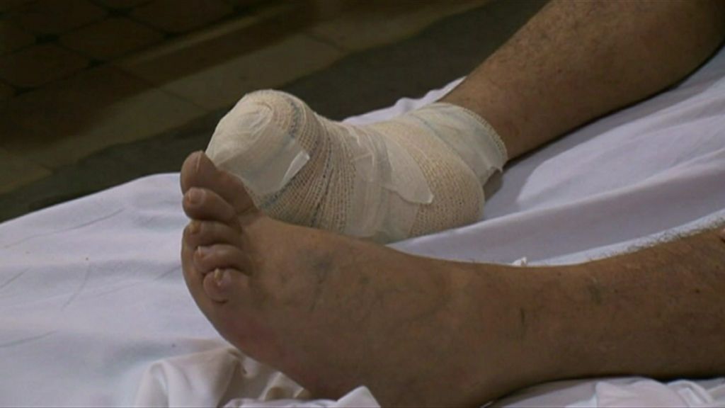 Rapid diagnostic test promises end to leprosy torment BBC News