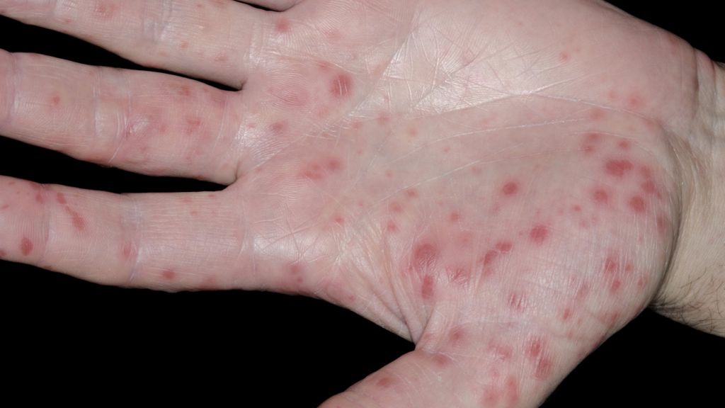 hand foot mouth virus