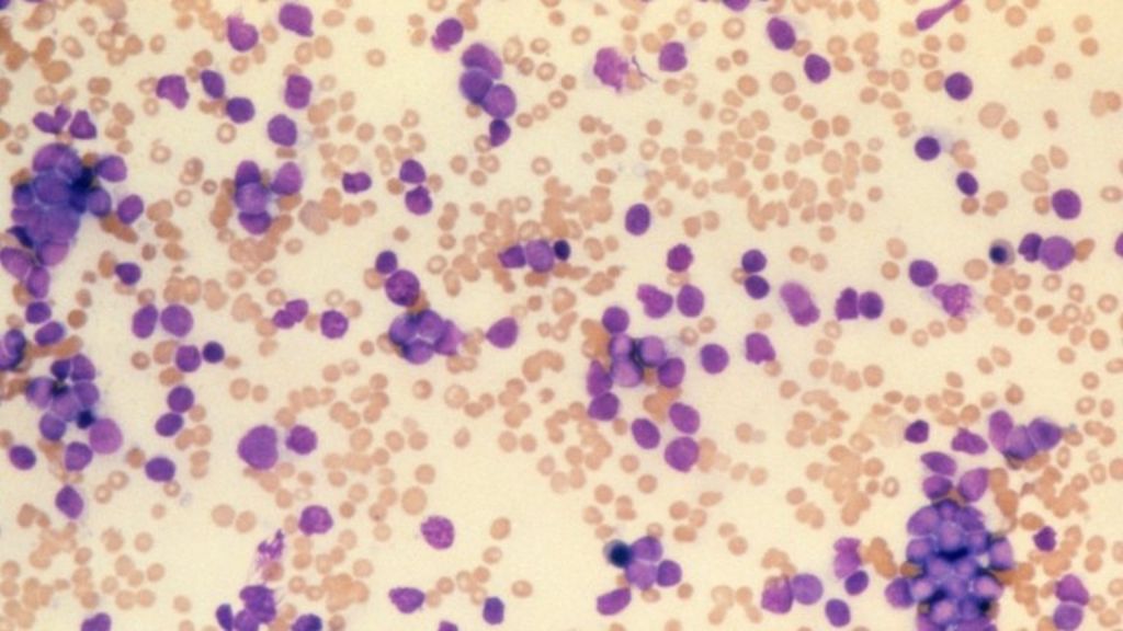 Aml leukemia prognosis in adults