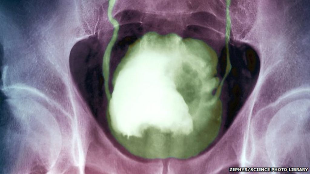 Why is no one talking about bladder cancer? BBC News