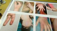 Hospital photos of burns