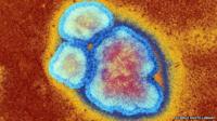 Measles