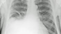 pneumonia