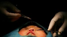 A child undergoes cleft palate surgery by charity Operation Smile in Xian, China (2007)