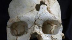 Ancient skull showing evidence of traumatic head injury