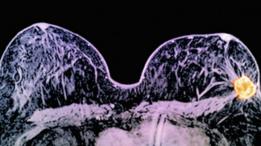 Para los expertos, este hallazgo es un "trampolín" para el tratamiento del cancer