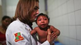 Doctora con un niño con microcefalia.
