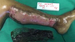 Quemaduras tratadas con piel de tilapia