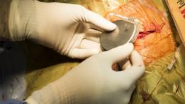 Un médico implanta un marcapasos en el cuerpo de un paciente.