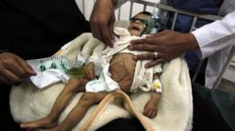 الصراع في اليمن جعل ملايين المواطنين ينزحون داخل البلاد وأدت الحرب إلى انتشار الأمراض وسوء التغذية