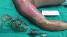 Quemaduras tratadas con piel de tilapia