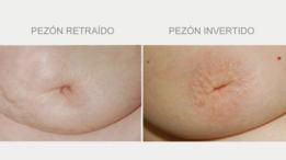 Pezón retraído y pezón invertido