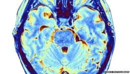 Cerebro