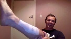 James Grant shows wound from shark attack